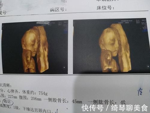 彩超|被宝宝的四维彩超照丑哭了?不是医生技术不好,而是有客观原因的