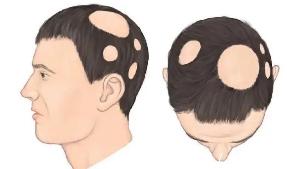 手术 斑秃植发多少费用,有影响么?科普干货为你分析,2022新参考价!