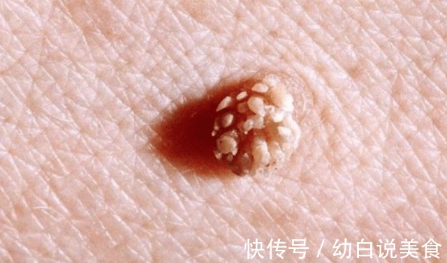 宫颈癌|21岁女子查出宫颈癌,医生皮肤3个异常,或不是过敏,建议了解