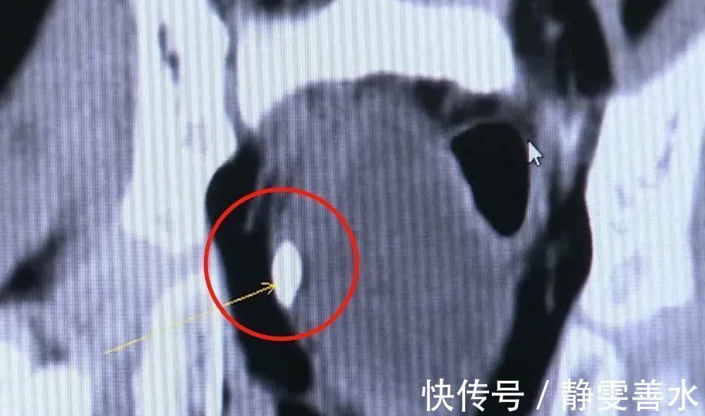 肾结石|5岁女童患尿路结石…送医时已发烧、抽搐、呼吸困难爸妈注意了