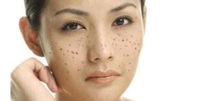 你脸上有色斑吗?别怕!茜茜教你一个科学、专业、实用的祛斑方法