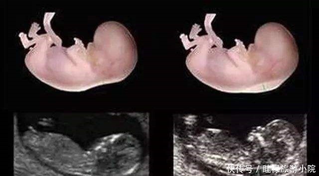 医生|孕期产检不想生个“傻孩子”,这三项产检必须按时做,不能忽视