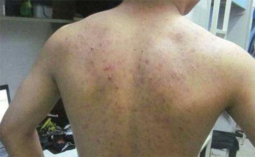 排螨|后背总能抠下一粒粒的东西？那就说明你该排螨了