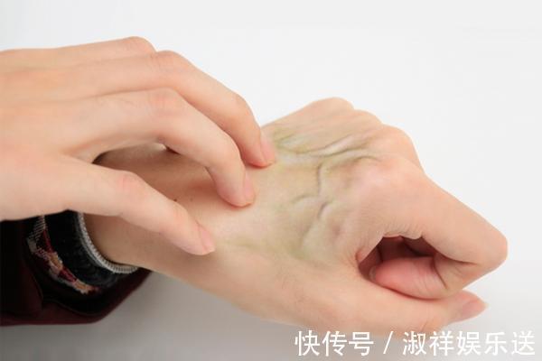 青筋|血管好不好,手不会骗你!若手上出现此3“异象”,该养血管了
