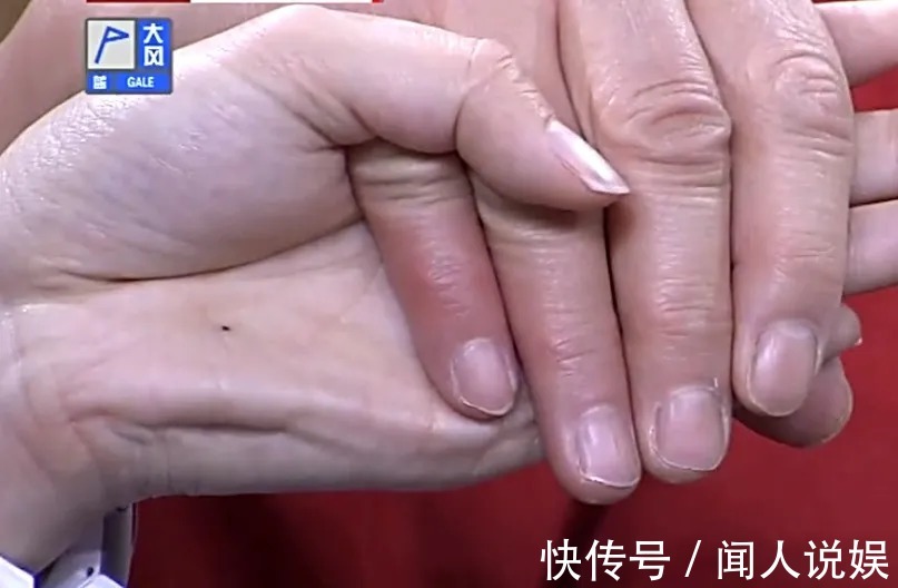 青筋|身体好不好，看手就知道！这几处变化可能藏大病