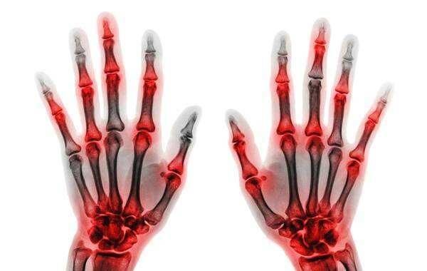 二个痛风好方子一个止痛一个降酸,不妨试试