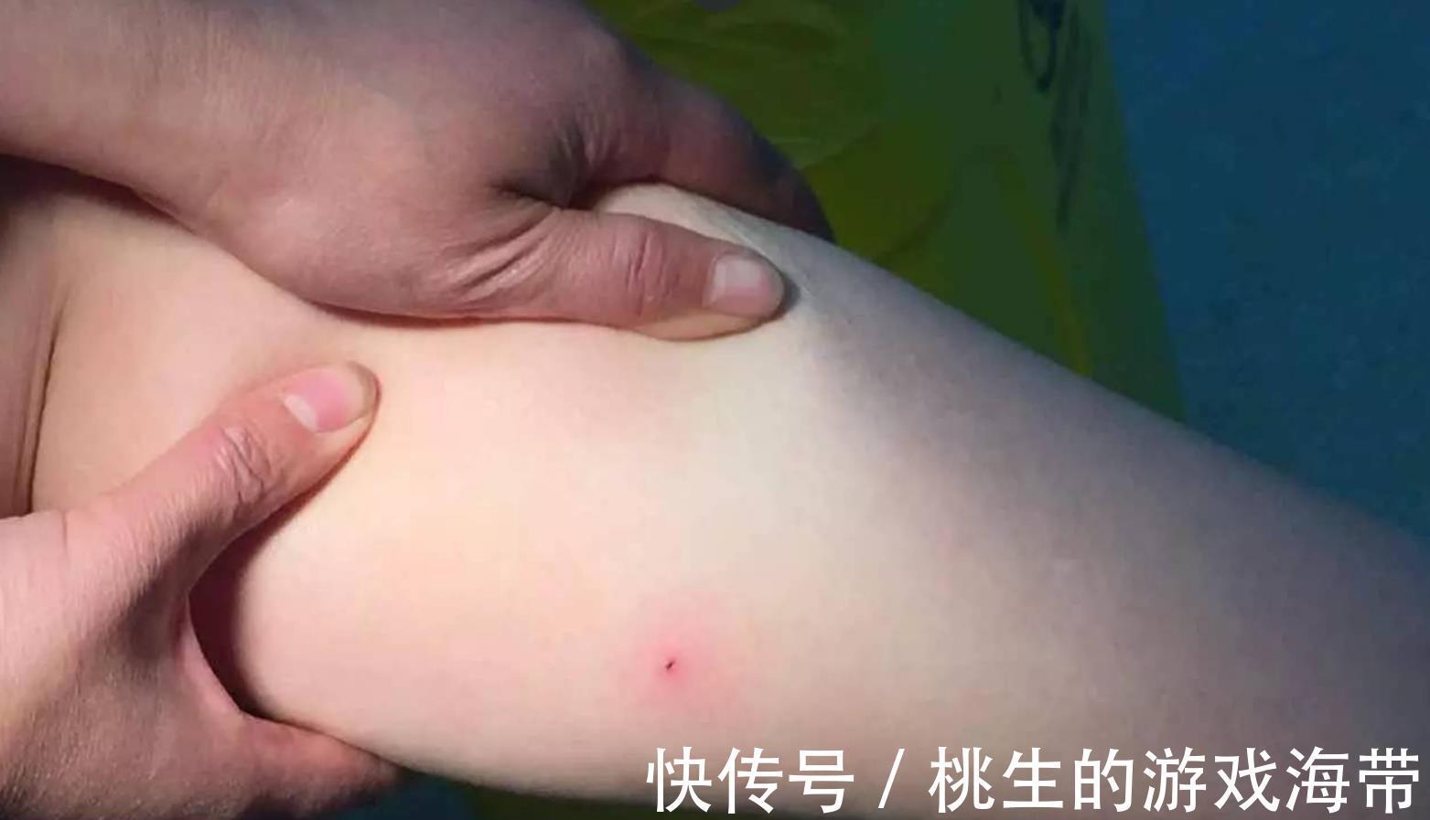医生|夏天蜱虫多，孩子被咬后别硬拔，宝妈学会三个急救法，医生都夸好