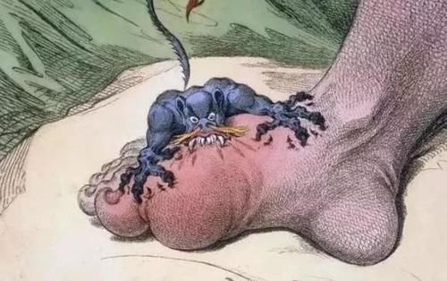 食物|豆制品是痛风“发物”？医生建议：这4类食物，真该少碰，别贪嘴