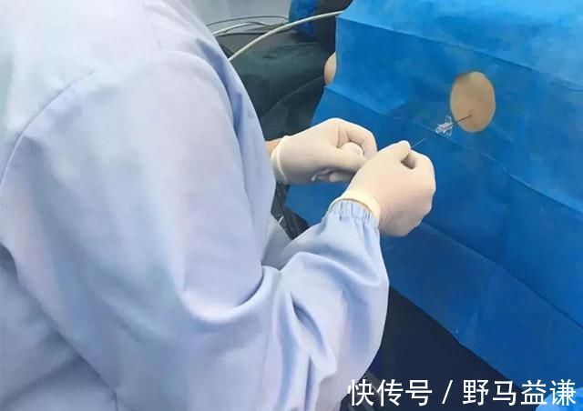 伤身|产妇剖腹产时,多次要求加大麻醉量,原因让医生一愣:副作用伤身