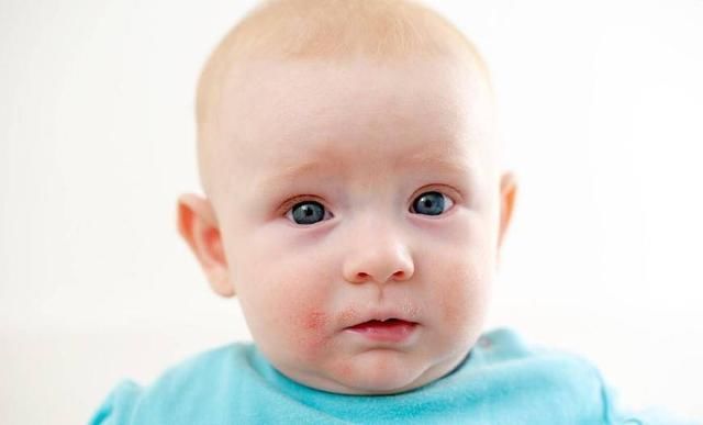 家长|新生儿容易起湿疹 都是家长错误的护理造成的 要注意这些细节