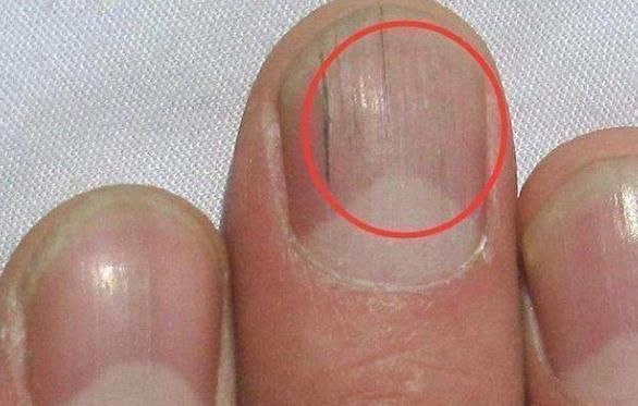 慢性炎症性皮肤病|身体生病,指甲先知?指甲若有5种表现,或许是疾病的“信号”!