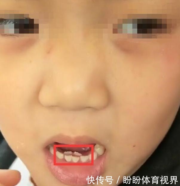 欢欢|8岁男童长出“双排牙”,只能一颗颗拔掉,奶奶几度失控:都怪我
