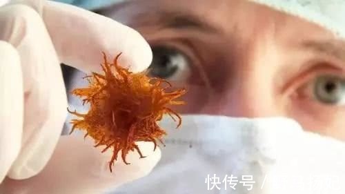 肿瘤|为何有些癌症到了晚期，却没有症状医院检查才发现