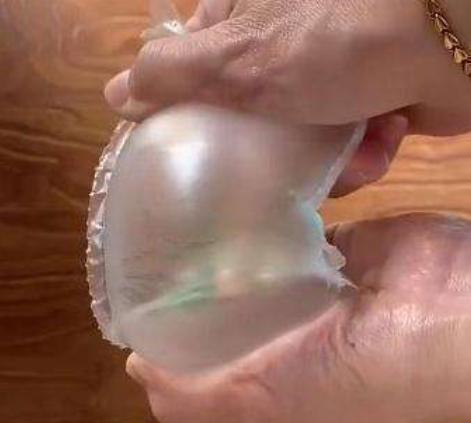 宝妈|妊娠纹是如何形成的丈夫们都该来看看,母亲的苦难应该被理解