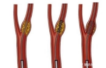 颈动脉|颈动脉堵塞随时会引来脑梗,医生说:多吃2种蔬菜,对血管好处多