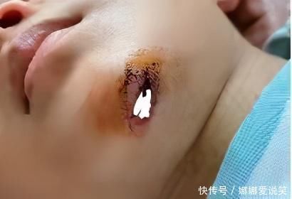 小宝|孩子误吞硬币、意外受伤该怎么办？儿科医生提醒：这样做才正确