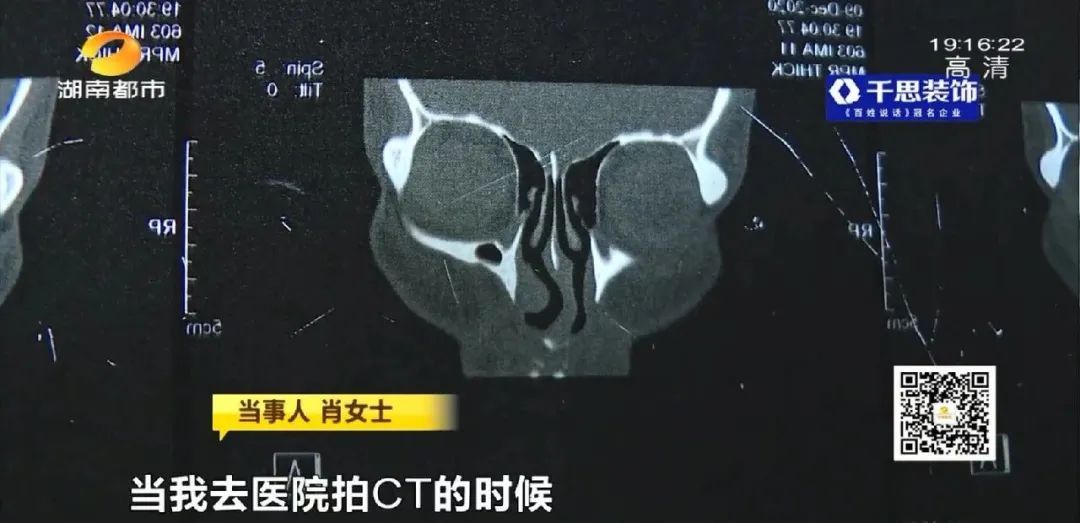 芯美昕|长沙一女子隆鼻后，多次睡梦中被憋醒！