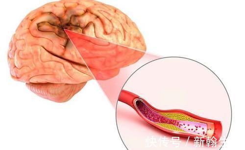 胆固醇|高血脂最爱3种肉,若能做到忌口,血脂自己往下降,人健康10倍