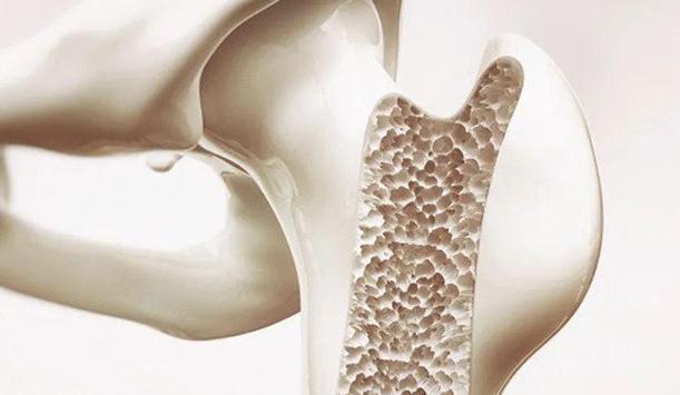 钙片|骨质疏松，钙片什么时候吃最好？会不会致肾结石？