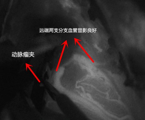 医院的“拆弹”专家！2岁孩子脑子里长了这个东西，可能即刻死亡