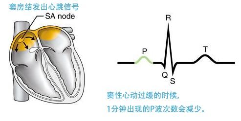 窦性心动过缓|官方认定「心动过缓」的标准，心跳慢到什么程度要看医生？