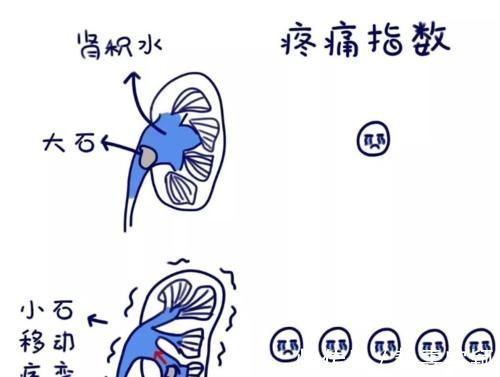 痛风性肾病|尿酸高影响肾功能吗？医生：痛风患者请做好十件事，保肾降尿酸