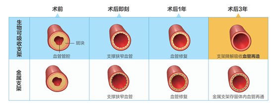 冠心病|创新冠心病“介入无植入理念” 助力患者“血管绿色重建”