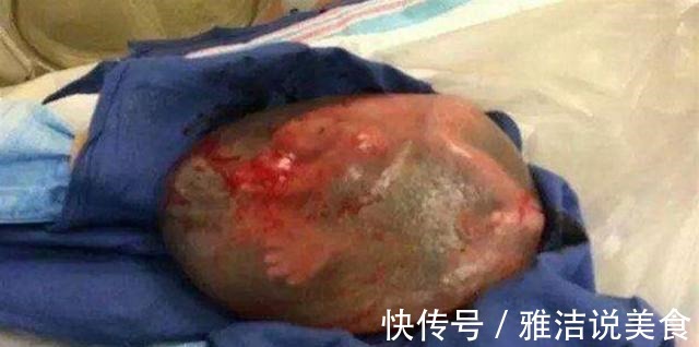 孕期|现实版“哪吒”产妇生下“带壳”宝宝痛哭,医生却说恭喜你