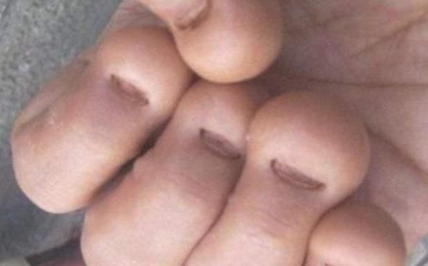 肠胃疾病|3岁小男孩爱啃指甲,妈妈紧急纠正,奶奶:不就吃个手,有啥要紧