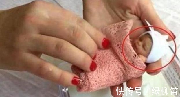 早产儿|''拇指姑娘''出生时仅25厘米，被诊断活不到1岁，结果却出人意料