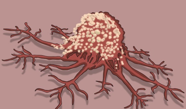 肝癌|医生提醒大家，得了癌症，皮肤是会给出信号的，4点异常较为明显