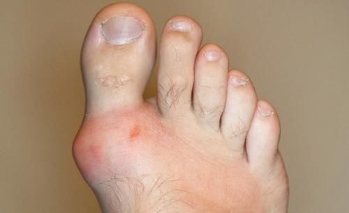 高脂血症|人为什么会得痛风?医生:想要成功预防痛风,做好这3点很重要