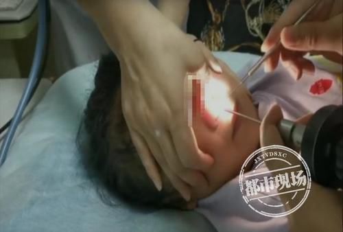 珠子|4岁女童鼻里塞珠子,妈妈竟自己掏,险些要了孩子的命