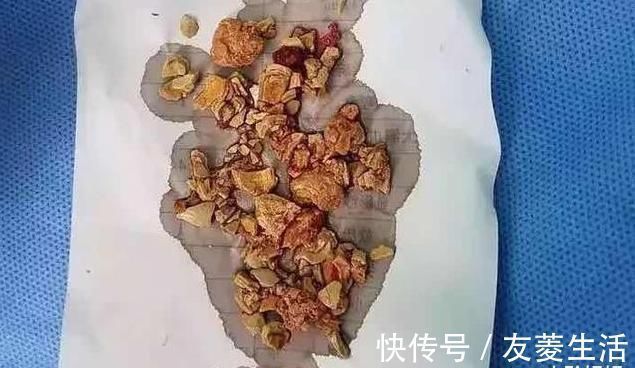 婴儿|婴儿患“肾结石”,与辅食有关系,医生:很常见多数家庭都在喂