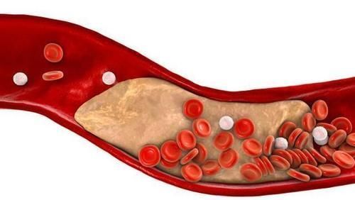 斑块|血脂高不高,看头就知道,血脂高的人,或有这三个表现,愿你没有