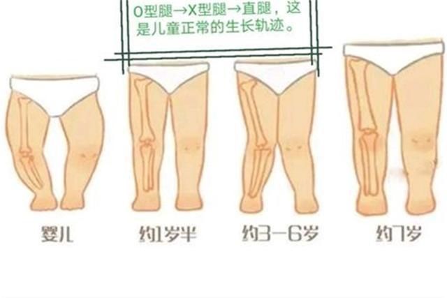 髋关节|父母的4种做法，可能导致宝宝骨骼畸形，别大意，不少人犯