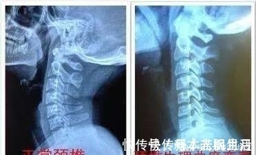 生理位|预防颈椎病,睡眠姿势很关键,听听医怎么说