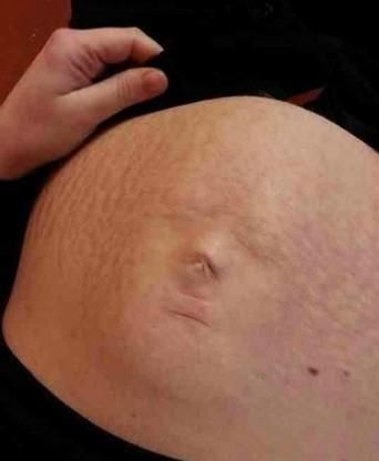 彩超|做四维医生说腹部脂肪厚,看不清,打出来单子也只能看宝宝大概面部怎么办?