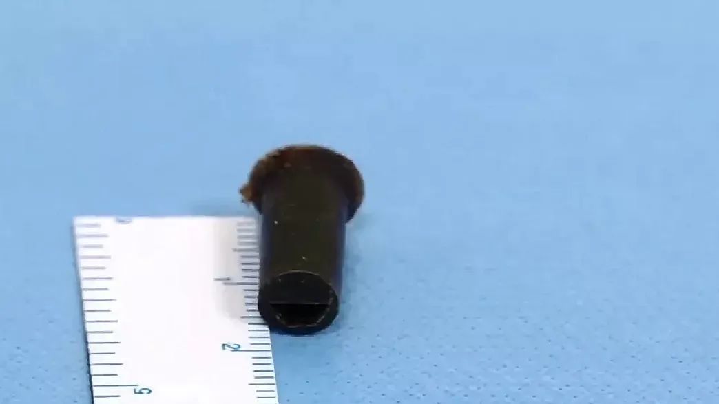 帅哥|帅哥6岁吞哨子因怕被骂瞒了20年，如今咳得不行了才做手术取出