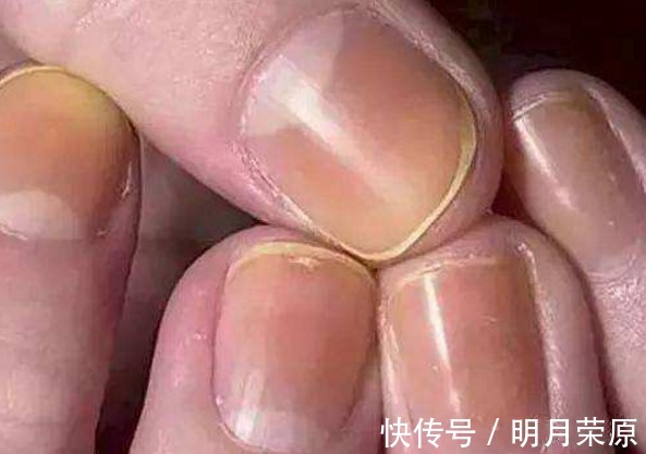 肝脏|肝脏没有痛觉，发现就是晚期！手上出现3种信号，提示你病变了