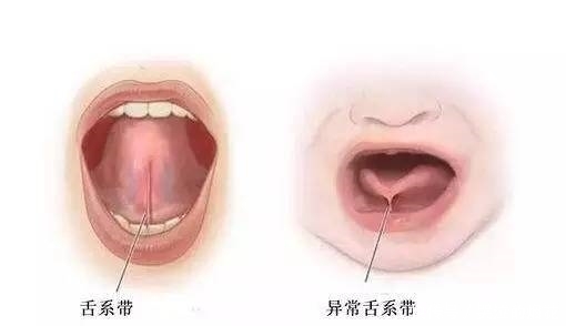 剪刀|思量再三还是带宝宝去剪舌系带,医生那一剪刀看得我心好疼