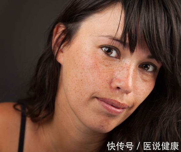 预防|女性不想黄褐斑找上门，不妨坚持这4件事，或能有效预防