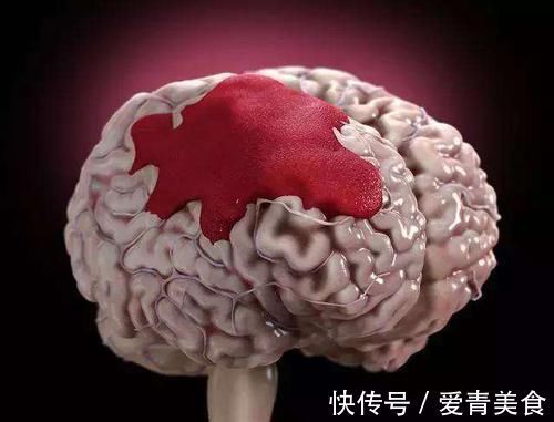 脑血栓|做好这5件事可稳定血压,警惕高血压对脑组织的3大损害