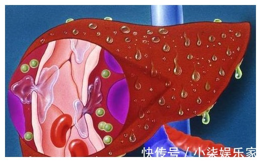 肝癌|42岁男子，肝硬化到肝功正常，只用了1年，平时爱吃“1红”是关键