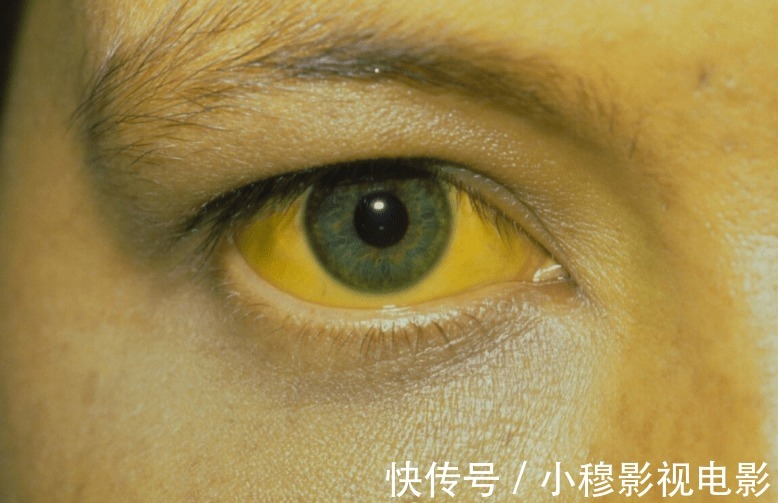 乏力|肝癌“诱因”已公布,医生提醒:身体出现3个症状,趁早查肝CT