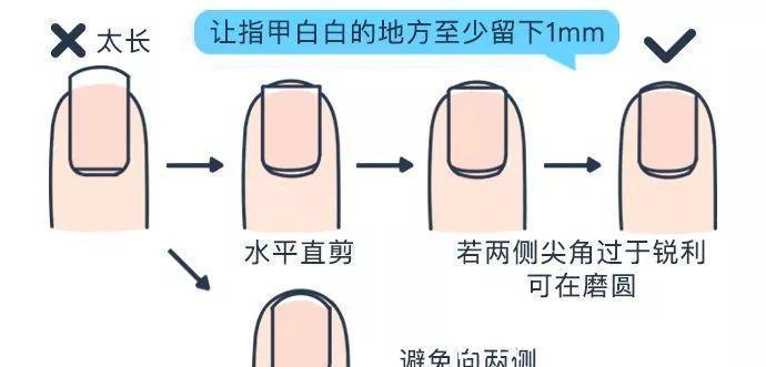 趾甲|给婴幼儿剪指甲可不简单, 我的孩子被剪成了甲沟炎