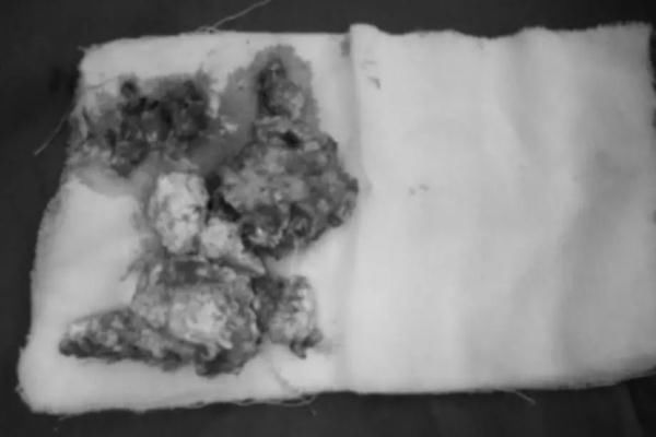 痛风患者|看着都痛!男子长出一对“生姜手”,只因爱吃……