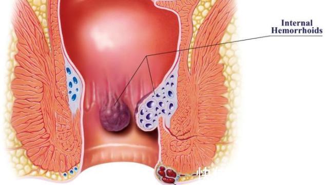 痔疮|痔疮肉球疼痛难耐怎么办？肛肠专家：全面痔疮知识分析，快速治痔只需三步！