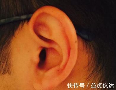 手术|宝宝耳朵上有个洞, 以为是好事, 知道真相, 妈妈懵了