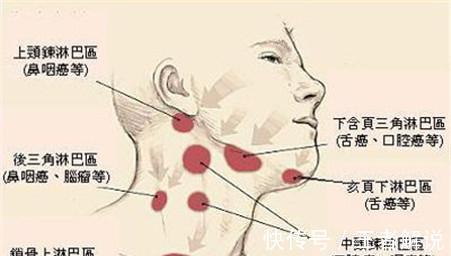 误诊|很会伪装的3大恶性肿瘤，往往发现便是晚期！出现这些症状莫大意